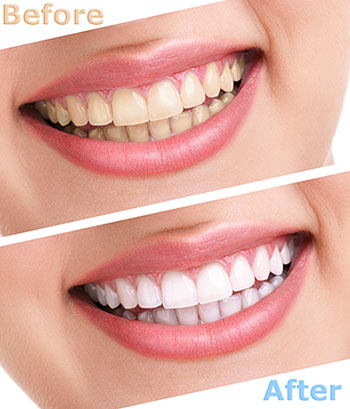 John G. Fletcher, DMD | Implant Dentistry, Dental Cleanings and Snoring Appliances