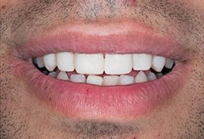 John G. Fletcher, DMD | Dentures, Dental Cleanings and Oral Cancer Screening